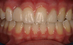 Teeth repaired with fixed bridges