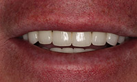 Man smiling closeup after dental crowns