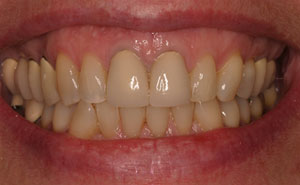 Closeup of unhealthy teeth and gums before treatment