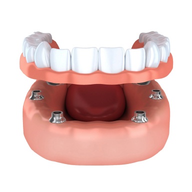Model of dental implant-retained dentures in Long Island