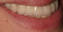 Closeup of left side of smile with implant denture