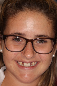 Young girl with missing teeth before implants