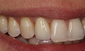 Missing tooth closeup after implants