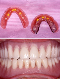 Inside of implant denture and full implant denture in place