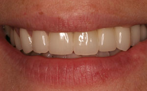 Flawlessly repaired teeth after makeover