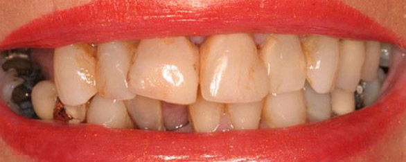 Closeup of teeth before cosmetic dental treatment in Massapequa Park