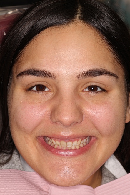 2020 patient with dental discoloration