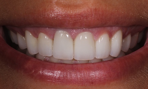 Close-up of whiter teeth positioned properly