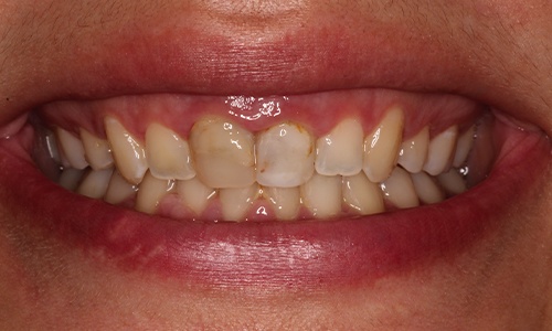 Close-up of discolored teeth pointing inward