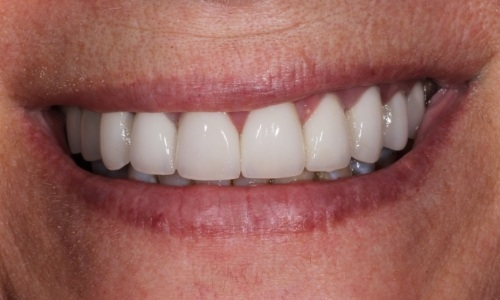 Close-up of teeth that look brighter thanks to veneers