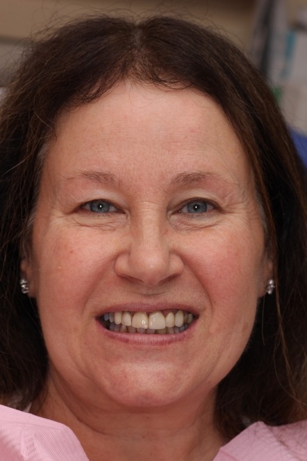 Older woman with darkened and worn-down teeth