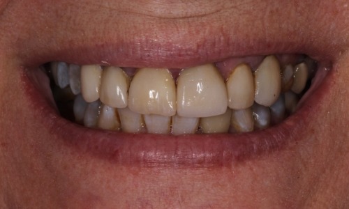 Close-up of teeth that are noticeably darkened