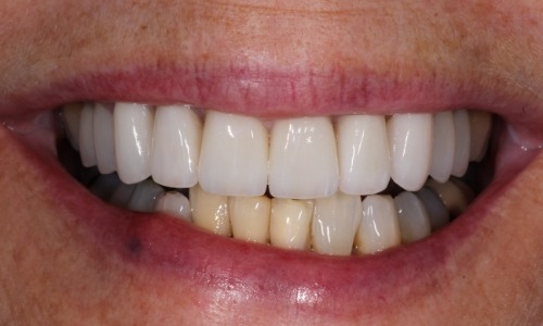 Close-up of Gail's smile after receiving dental crowns