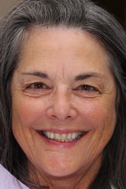 Headshot of Gail before her dental treatment
