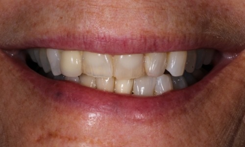 Close-up of Gail's smile before receiving dental crowns