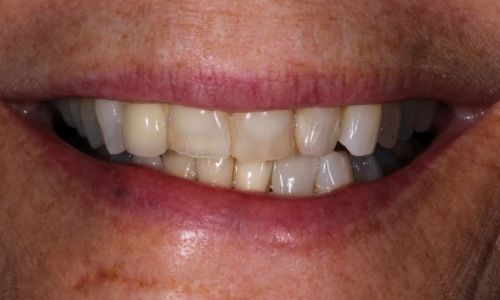 Closeup of before Long Island Porcelain Crowns