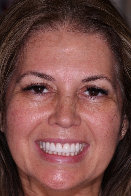 Dental patient Nancy showing smile improved after smile makeover