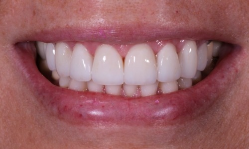 Whiter-looking teeth with damage hidden