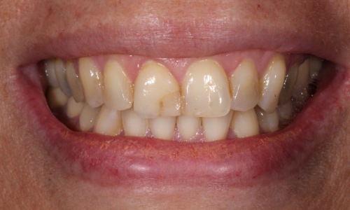 Close-up of discolored teeth with visible damage