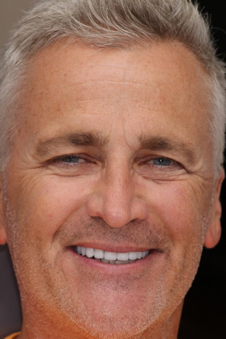 After picture of dental patient Rick