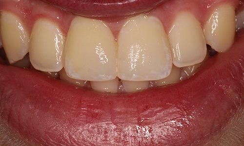 Close-up of front teeth that have been repaired with bonding