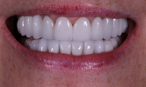 Dental patient Cathy's smile after treatment
