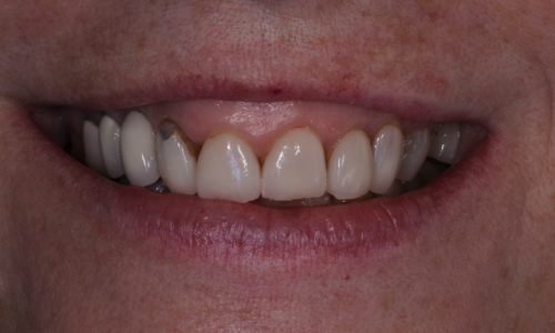 Dental patient Cathy's smile before treatment