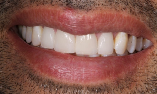 Close-up of Imram's teeth after dental work