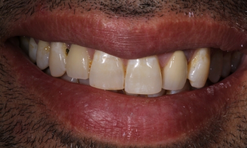Close-up of Imram's teeth prior to dental work
