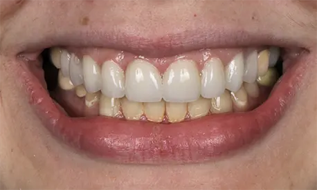 Patient Abby smiling after cosmetic dental treatment