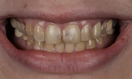Patient Abby smiling before cosmetic dental treatment