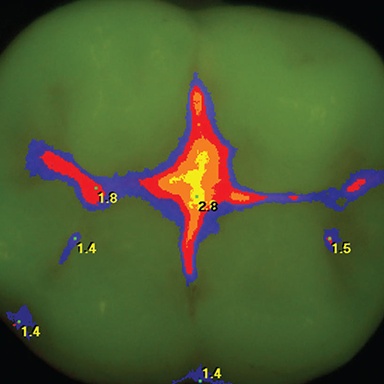 Spectra caries detector system