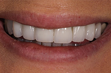 Dental patient Alex's smile after quality dental care