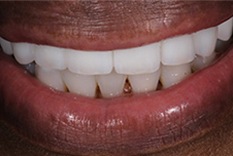 Beryl's smile after receiving dental implants and bonding
