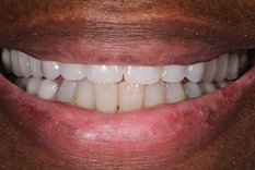 Close-up of smile with repaired teeth