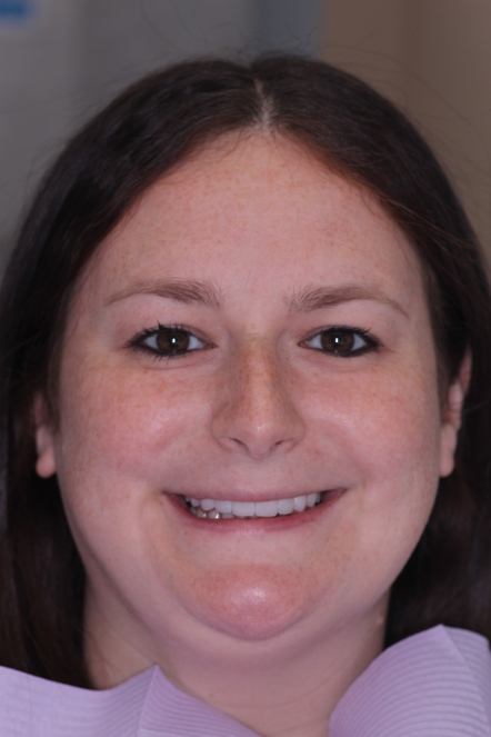Alaina smiling after receiving crowns from Long Island Cosmetic Dentist, Dr. Allan Mohr