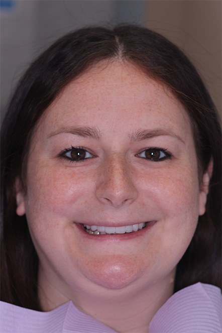 Headshot of Alaina after veneers
