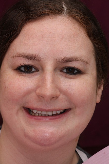 Headshot of Alaina before veneers