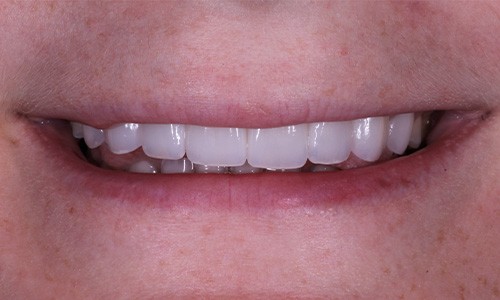 Close-up of Alaina's smile after veneers