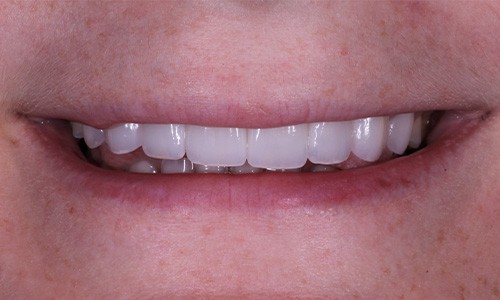 Closeup of   after Long Island veneers