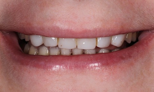 Close-up of Alaina's smile before veneers