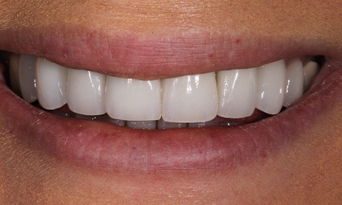 Close-up of teeth that look larger with veneers