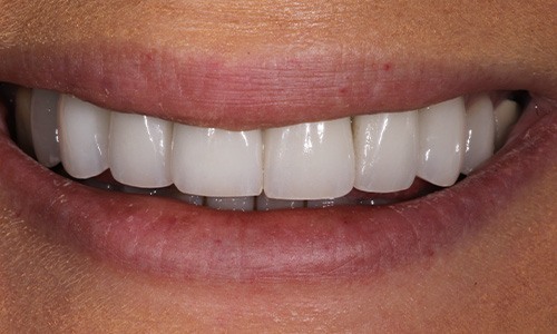 Closeup of Alexandra after Long Island veneers