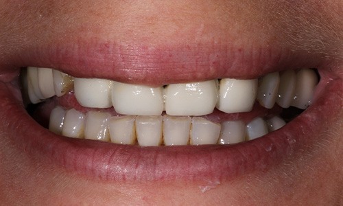 Closeup of Alexandra before Long Island veneers