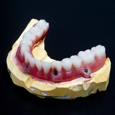 Model of All-on-4 dental implants in Massapequa Park
