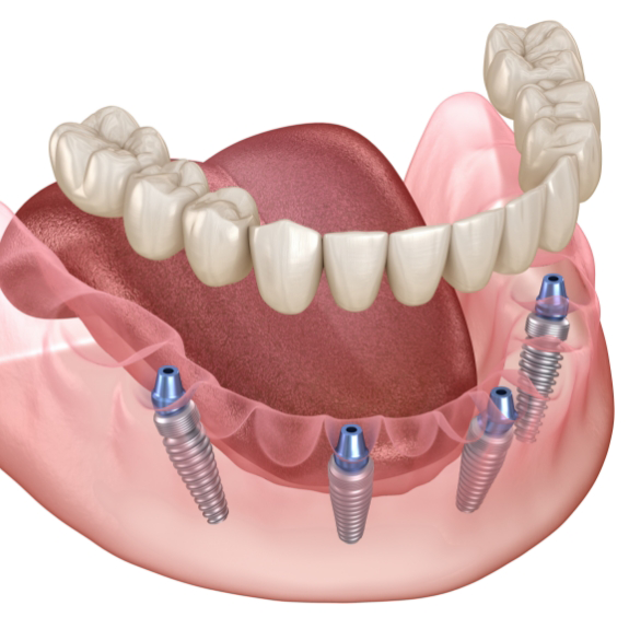 Illustration of a full denture being supported by four dental implants throughout the arch