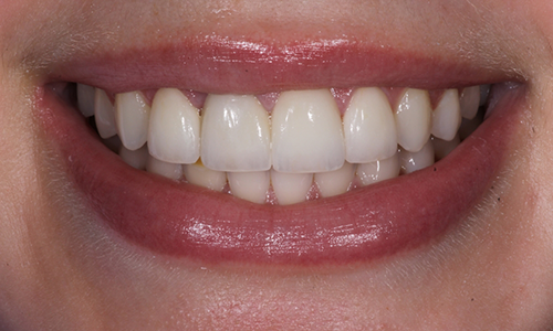 Close-up of smile with colors corrected via smile makeover