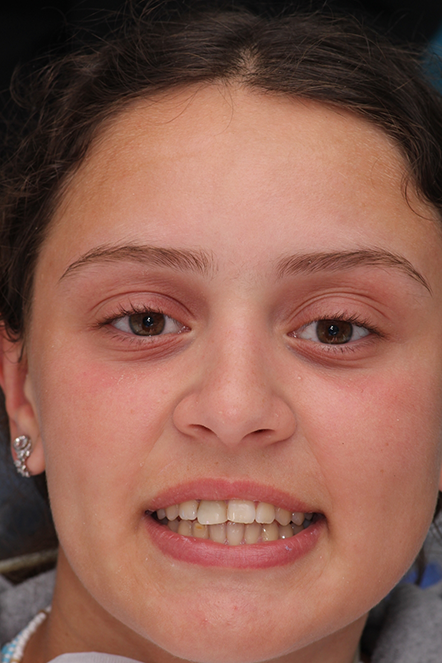 Headshot of Amanda before treatment
