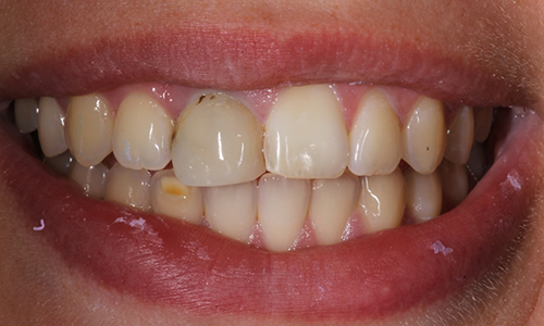Close-up of smile with multiple discolored teeth