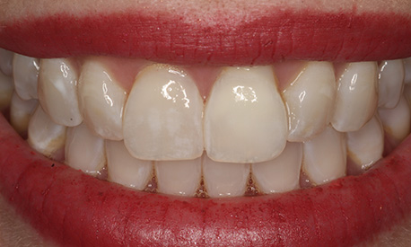 Smile of the Month June 2025 after treatment